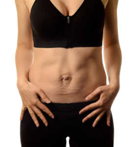 Picture of women's belly showing a separation of her abdominal muscles.